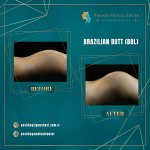 BBL Before After2.jpg BBL Before After2.jpg