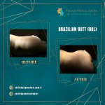 BBL Before After1.jpg BBL Before After1.jpg