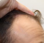 hair transplant in turkey.jpg hair transplant in turkey.jpg