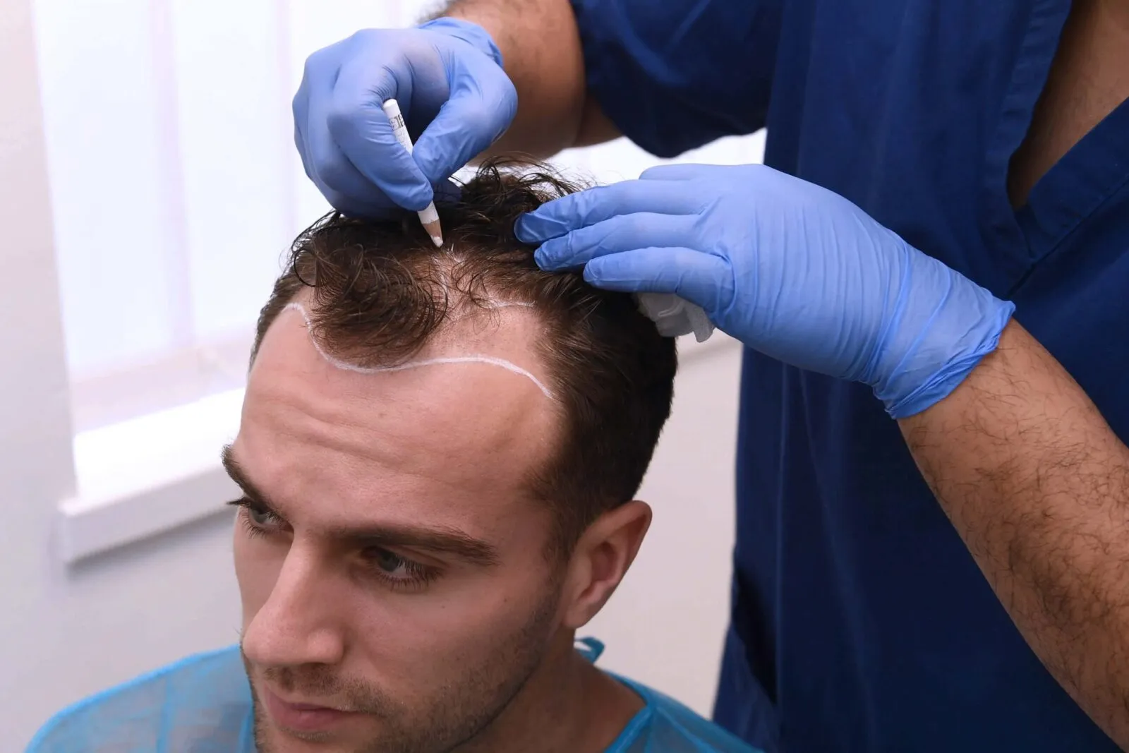 Hair Transplant